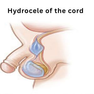 hydrocele of the cord