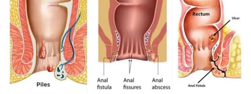 Piles & Hydrocele Without Surgery Treatment for Care. untitled design (31)
